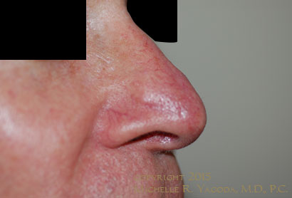 MOHs resection of cancer on the nose, AFTER repair, set 2